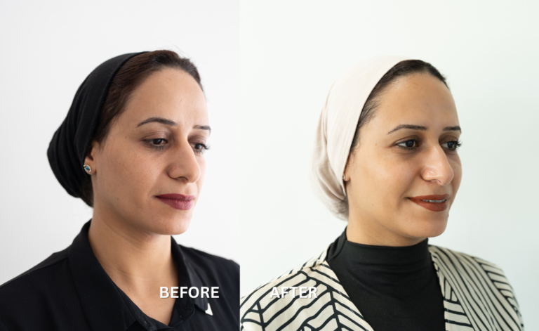 Achieve a Sculpted Facial Profile with Chin and Cheek Augmentation – Plastic Surgery in Qatar