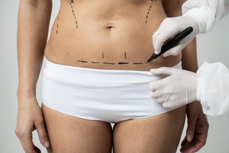 Fat Transfer: Natural Results with Lipofilling in Qatar